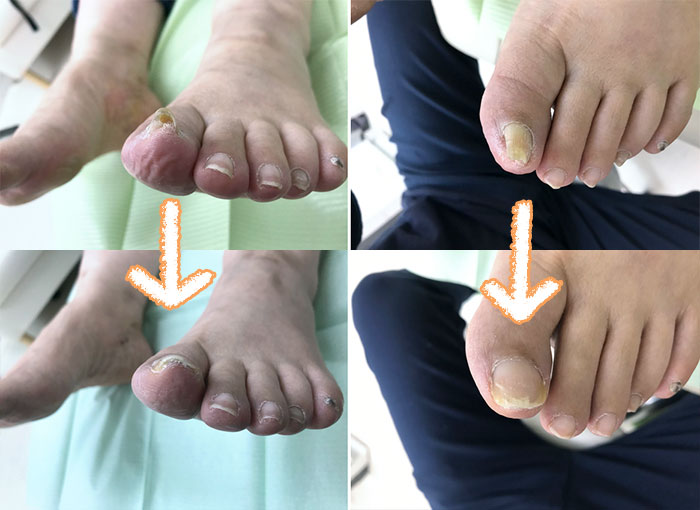 巻き爪画像5118左足の爪